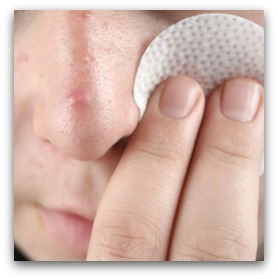 acneyoungpeople Acne Treatment